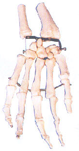 手掌骨模型